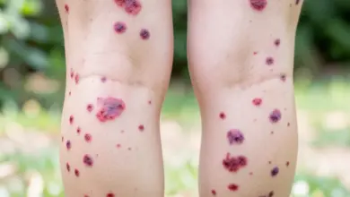 co je purpura příznaky a léčba - Co je purpura - ilustrační foto