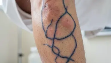 Jak poznat a léčit onemocnění žil - ilustrační foto