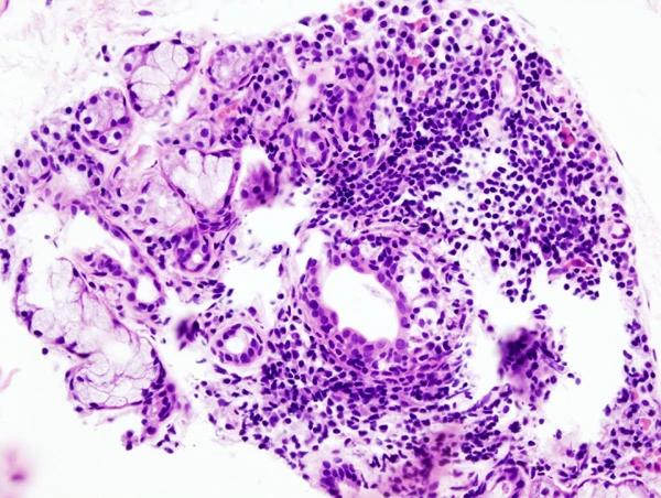 Histologický příznak suchého oka a úst při syndromu Sjögrena.