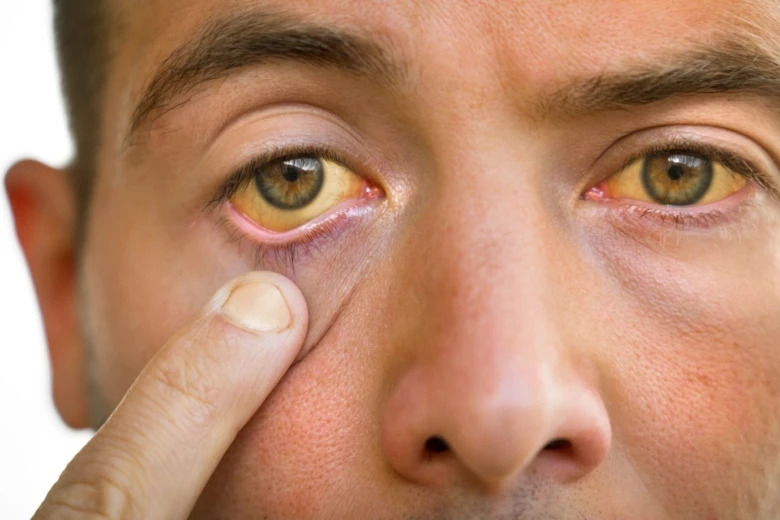 Man with jaundice eyes