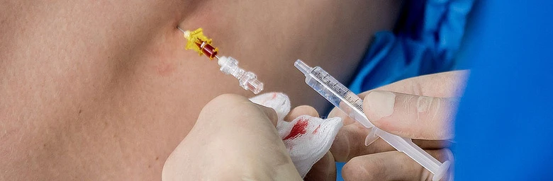 Zdravotník vkládá epidurální katétr do zadního otvoru pacienta.