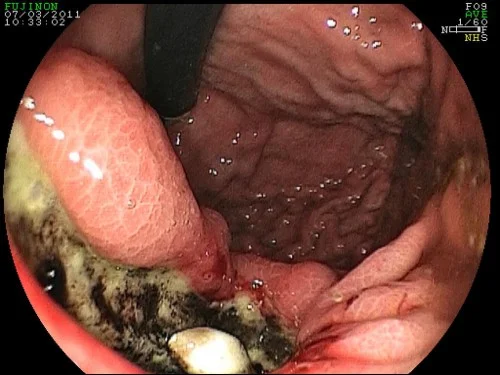 Stomach cancer lesion
