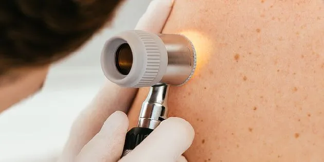 Dermatoskopie kůže pro vyšetření znamének na zádech.