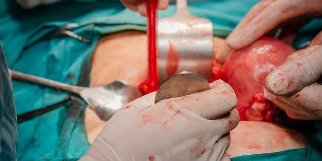 Operace hysterektomie s nástroji v těle pacientky