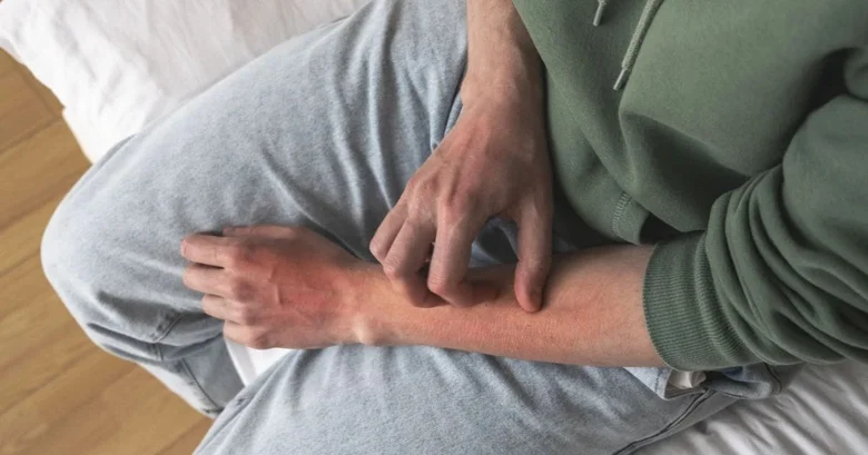 Muž škrábe červené místo na paži po vystavení chladu.