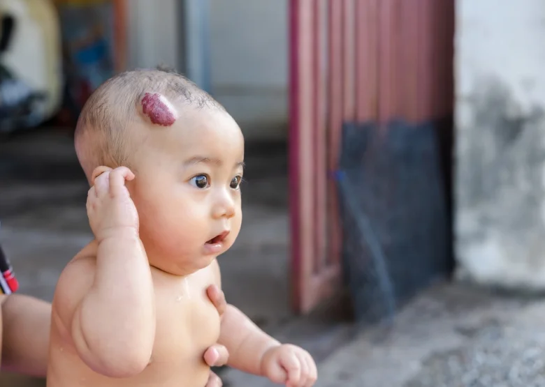 Baby with scalp hemangioma