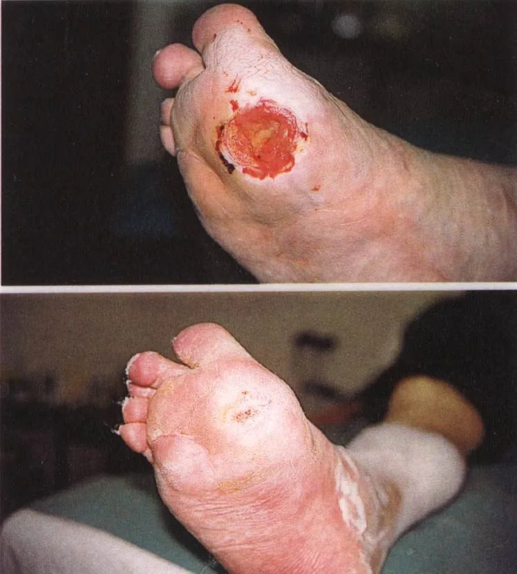 Před a po: hojení diabetického vředu na noze.