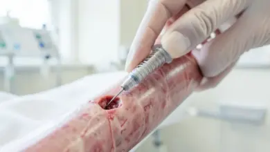 jak funguje stent a jeho výhody - Jak funguje stent - ilustrační foto