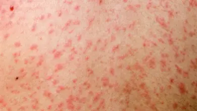 Výsev na kůži při spalničkách s červenými skvrnami.