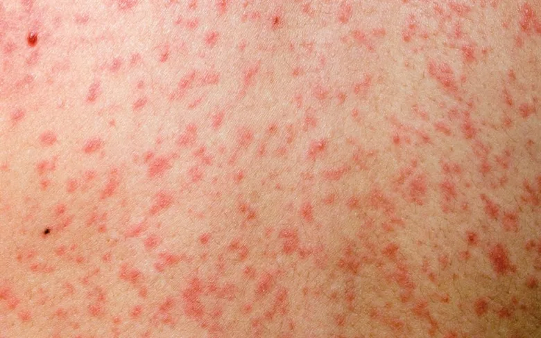 Výsev na kůži při spalničkách s červenými skvrnami.