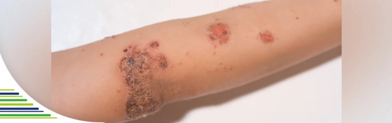 Fotografie ruky s příznaky impetiga v podobě červených krust.