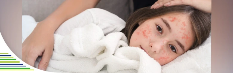 Child with measles rash