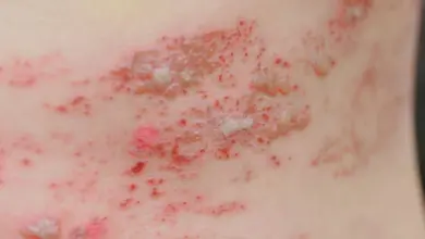 Shingles rash on skin