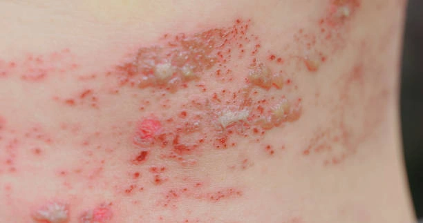 Shingles rash on skin