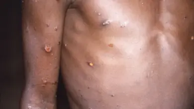 Tělo člověka s vyrážkou z opičích neštovic.