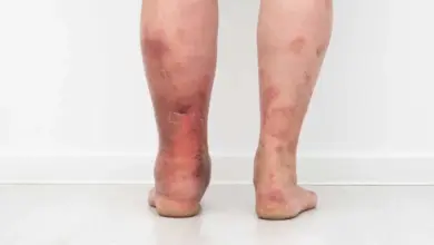 Zapálené nohy s příznaky bércových vředů.