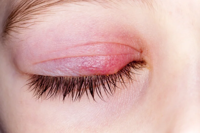 Red eye with stye