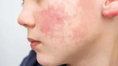 Dítě s červenou ložiskovou skvrnou na tváři způsobenou pátou nemocí.