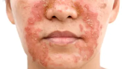 Seborrheic dermatitis face