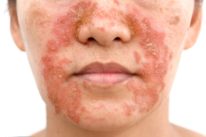 Seborrheic dermatitis face