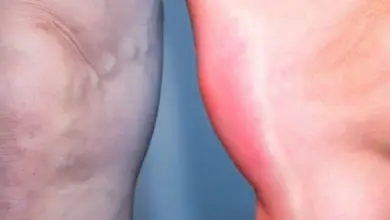 Swollen leg with redness and veins