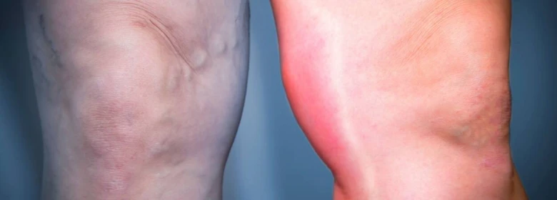 Swollen leg with redness and veins