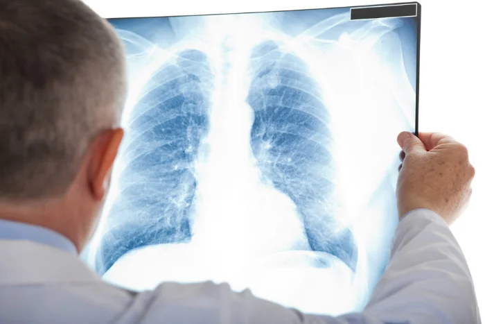 Lékař zkoumá rentgenový snímek plic na diagnózu pneumonie.