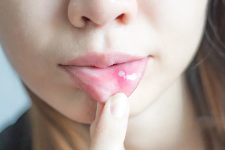 Mouth with canker sore