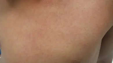 Červené vyrážky na hrudi jako příznak spály.