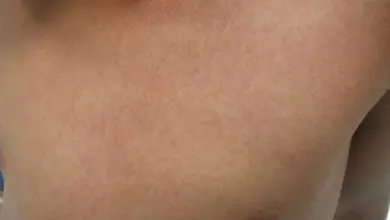 Příznaky spálené kůže na hrudi po slunečním záření.