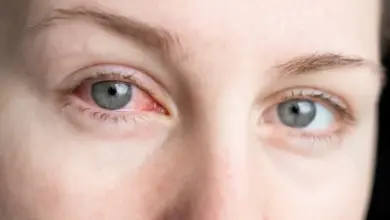 Zvětšený pohled na červené oko s příznaky zánětu spojivek.