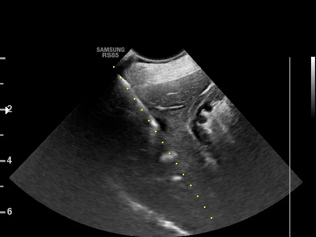 Ultrazvuková snímka jater pro diagnostiku fibrózy