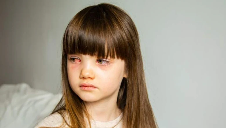 Dívka s červenýma očima ukazuje příznaky zánětu spojivek.