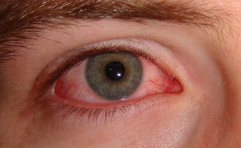 Červené oko s příznaky zánětu spojivek na fotografii.