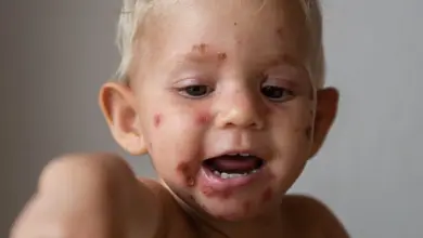 Malý dítě ukazující na vyrážku z impetiga obličeje.