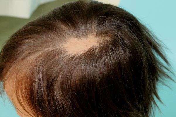 Přehled vlasů s viditelnou oblastí alopecie na skalpu.