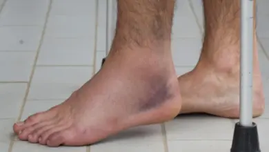 Injured ankle with bruising