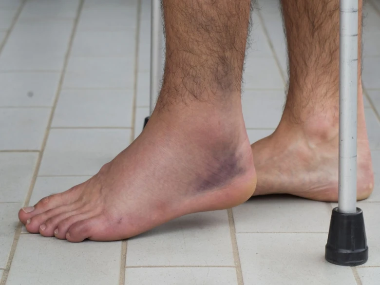 Injured ankle with bruising