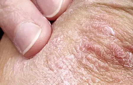 Psoriasis skin lesion