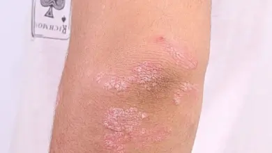 Červené šupinaté skvrny na lokti u lupénky.