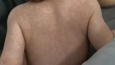 Červená vyrážka na zádech dítěte s pátou nemocí.