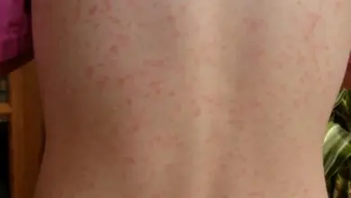 Záda dítěte s vyrážkou typickou pro spalničky.