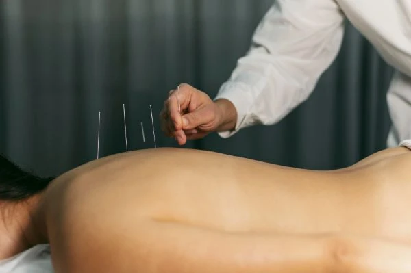 Akupunktura na zádech při léčbě fibromyalgie.